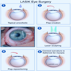 LASIK Eye Surgery for Vision Correction at Fort Worth Eye Associates